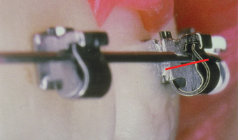 Clinical Torque Example 1