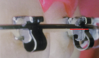Clinical Torque Example 2