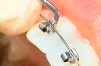 Opening by Gingival Dimple