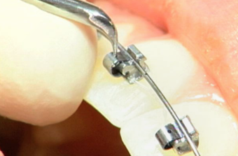 Opening SPEED With Labial Window