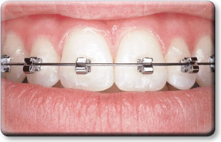 SPEED Braces