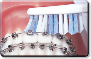Brushing SPEED Braces